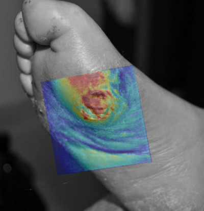 Example: hyperspectral image used to show the blood oxygen level (red = high) of an ulcer with delayed healing.