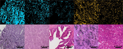Infrared (IR) imaging for microsatellite stable (MSS; light blue) and high microsatellite instability (MSI-H) versus hematoxylin and eosin (H&E) staining of the same tissue section. Shown are example images for three MSS colorectal cancers (CRCs; light blue) and two MSI-H CRCs (orange). The IR images present cancer spectra only; therefore, the background with other tissue types is black. Reproduced from Scientific Reports (doi: https://doi.org/10.1038/s41598-020-67052-z), CC-BY.