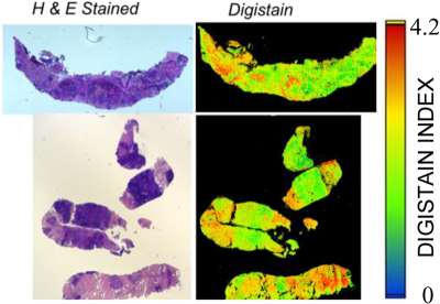A traditional stained biopsy (left) and a Digistain view (right). Reproduced from Convergent Science Physical Oncology, doi: https://doi.org/10.1088/2057-1739/aaabc3, © 2018 IOP Publishing Ltd.