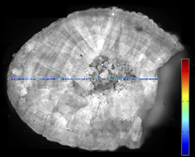 Rapid analysis of a kidney stone. © Fraunhofer IPM